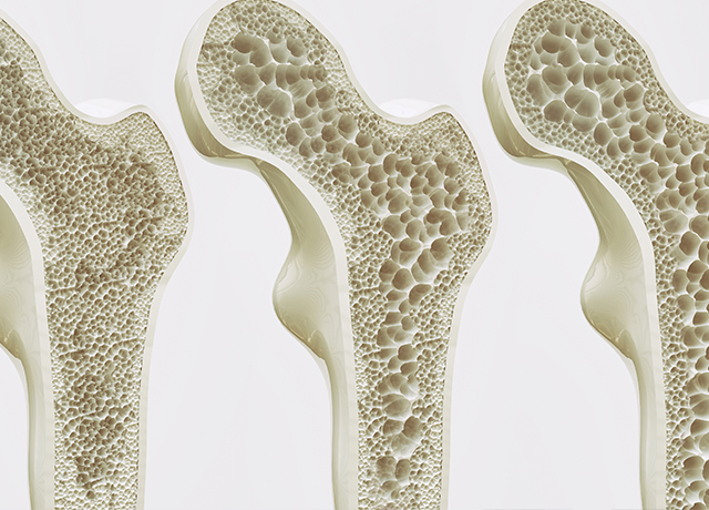 骨粗鬆症